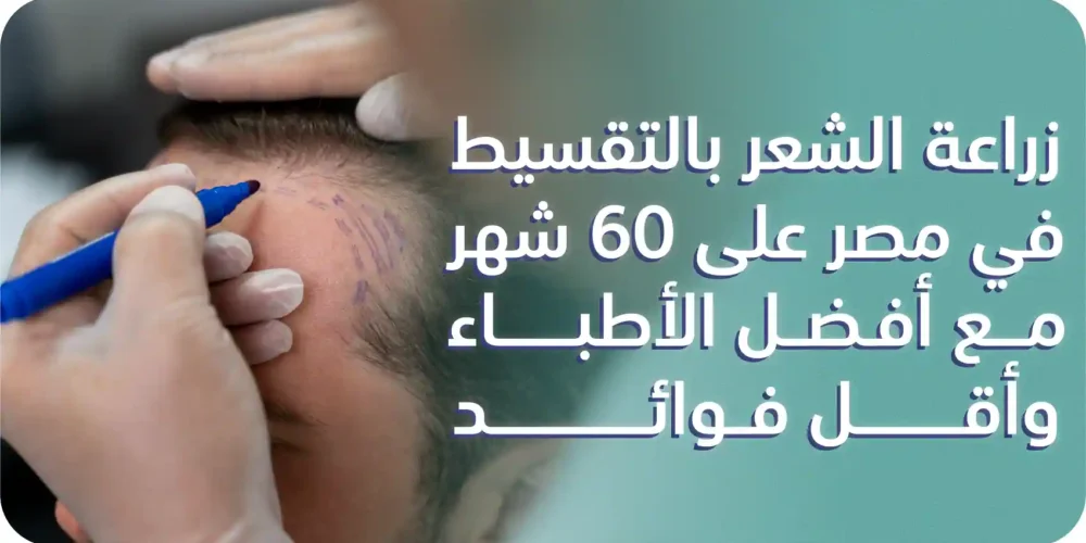 زراعة الشعر بالتقسيط